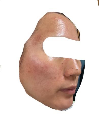 after photo: ダーマペン