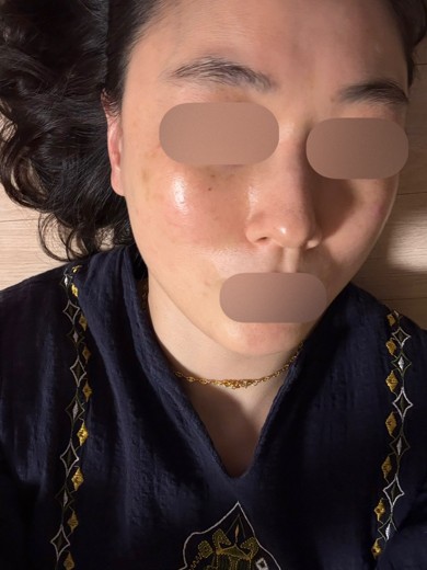 after photo: 스킨보톡스