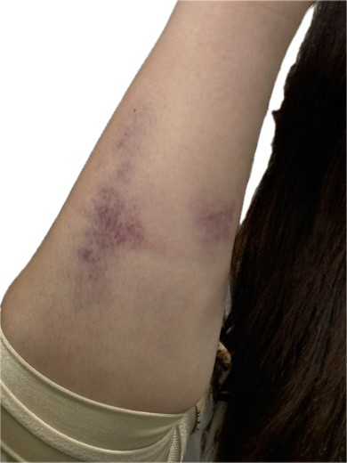 after photo: 팔지방흡입, 옆구리지방흡입, 복부지방흡입, 허리지방흡입