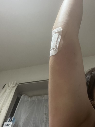 after photo: 脂肪吸引(腕)
