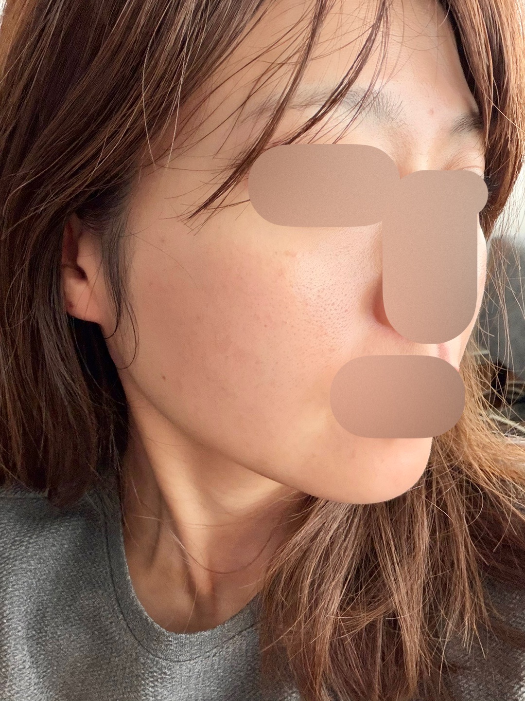 何度でも可】【女性限定】美顔レーザートーニング＋顔脱毛 | ZX-CLINIC