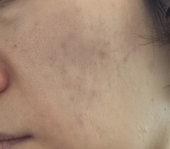 after photo: 리쥬란힐러