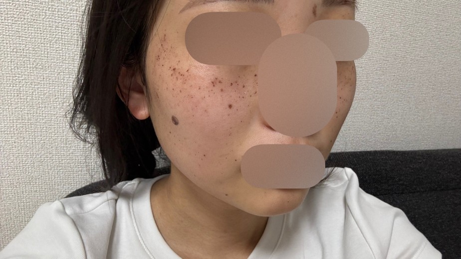 after photo: ルメッカ