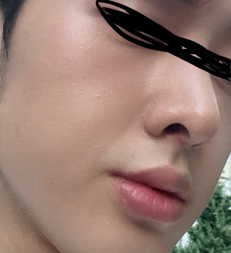 after photo: 콧대(자가조직), 콧볼축소