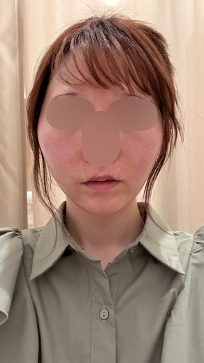 after photo: フラクショナルレーザー, エレクトロポレーション, Qスイッチレーザー