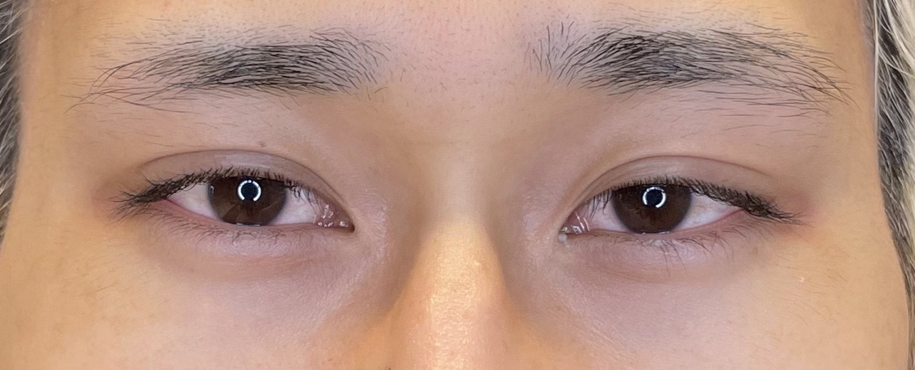 before photo: タレ目形成, 目尻切開