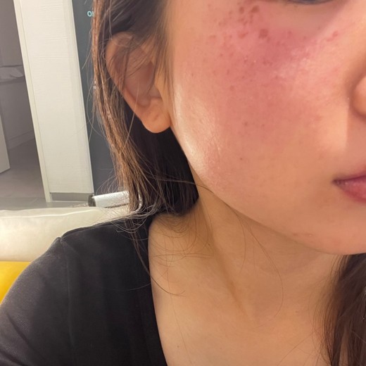 after photo: PDTレーザー, フラクショナルレーザー, レーザートーニング, ほくろ除去(レーザー)