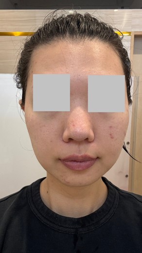 before photo: イオン導入