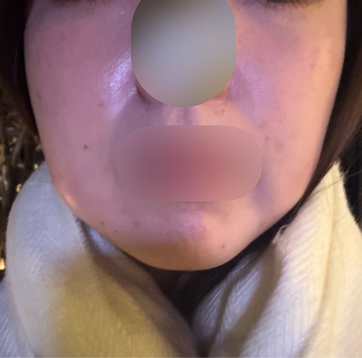 after photo: 脂肪溶解注射(顔)