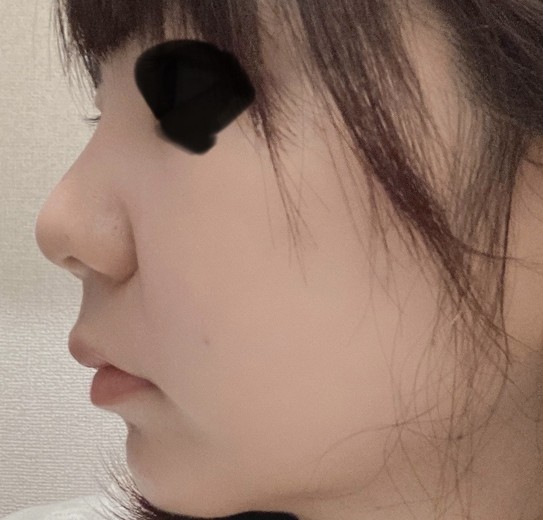 after photo: 糸リフト