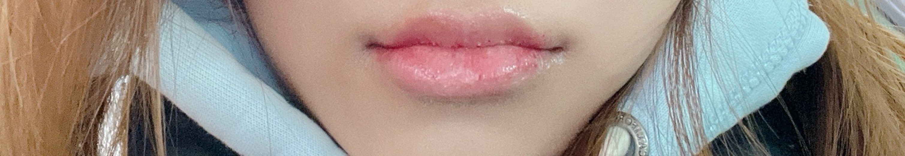 after photo: 입꼬리필러, 입술필러