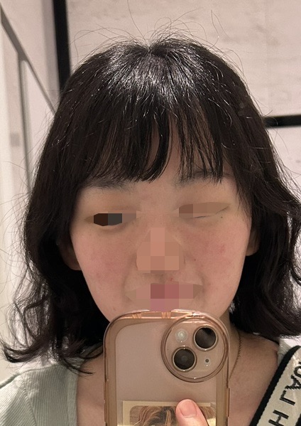 女性限定】顔脱毛｜ジェントルマックスプロ／ジェントルマックスプロ