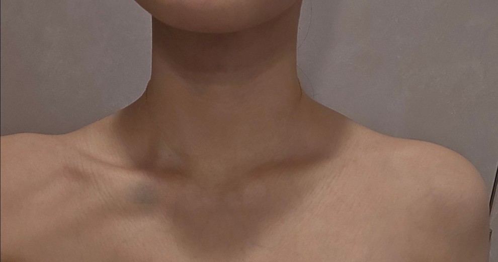 after photo: 肩ボトックス(僧帽筋)