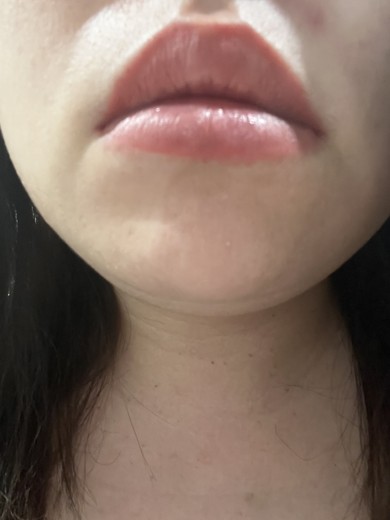 after photo: 脂肪溶解注射(顔)