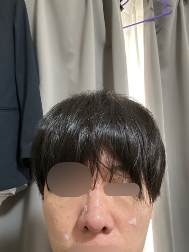 after photo: ダーマペン