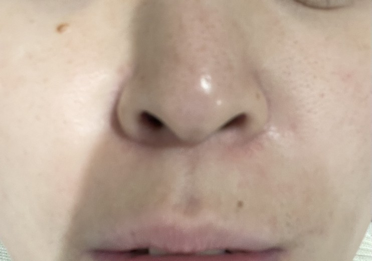 before photo: ダーマペン