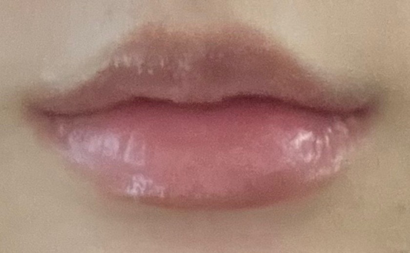 after photo: 입꼬리필러, 입꼬리보톡스, 입술필러