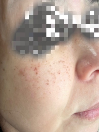 after photo: ピーリング, ルメッカ