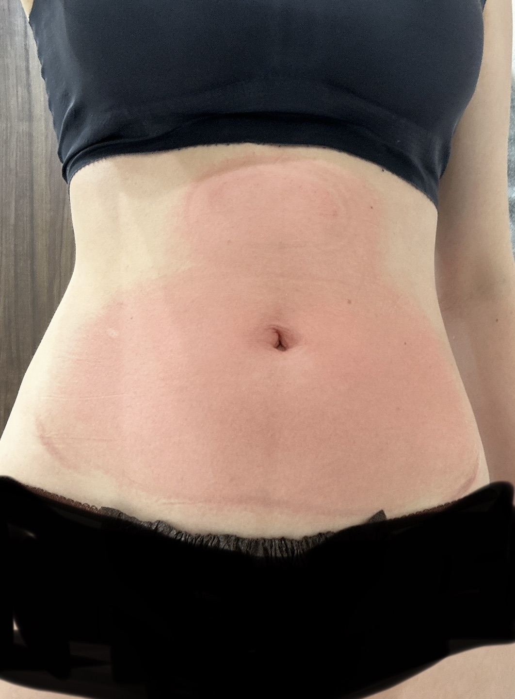 スノエル（脂肪冷却）2パーツ4ハンドル 部分痩せしたい方◎ | オルタ