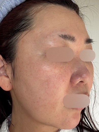 after photo: IPL(光/フォト治療), ルメッカ