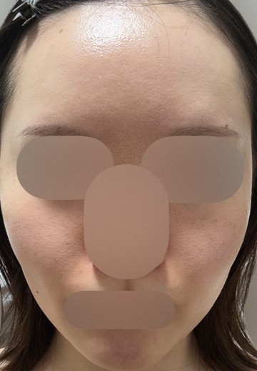 after photo: IPL(光/フォト治療), ルメッカ