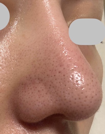before photo: ハイドラジェントル