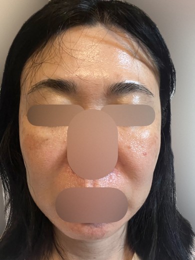 after photo: フラクショナルレーザー