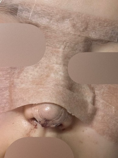 after photo: 비중격만곡증수술, 콧대(보형물), 코끝(자가연골)
