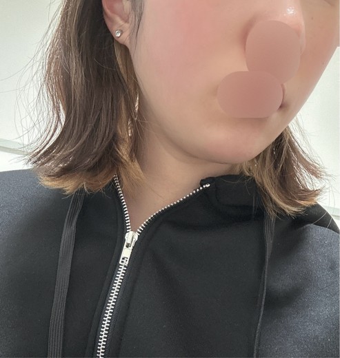 after photo: 脂肪吸引(顎下)