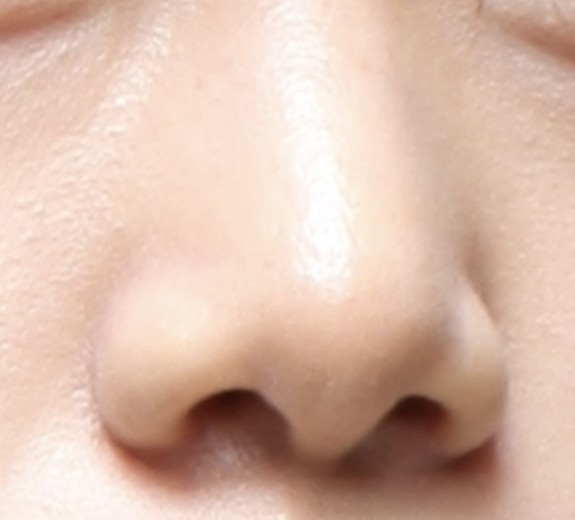 after photo: 콧볼축소