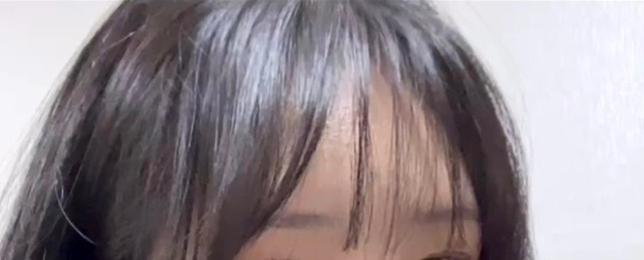 after photo: 이마필러