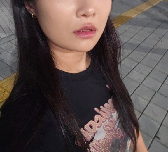 after photo: 팔자주름필러