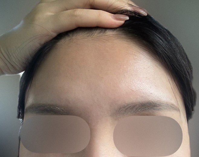 before photo: 이마필러