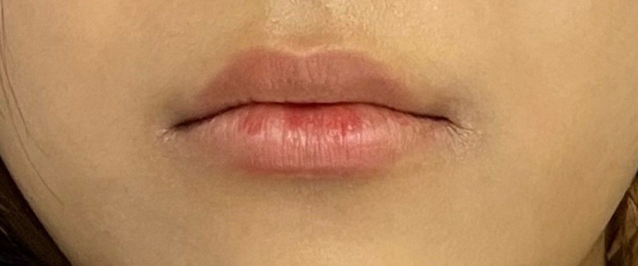 before photo: 입꼬리필러, 입술필러