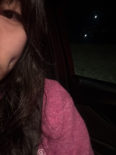 after photo: 보조개성형