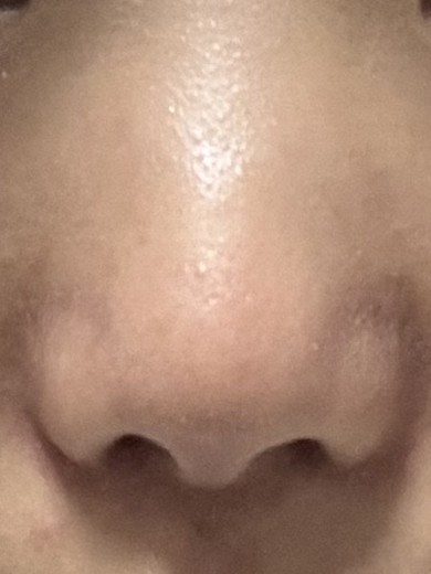 after photo: 콧볼축소