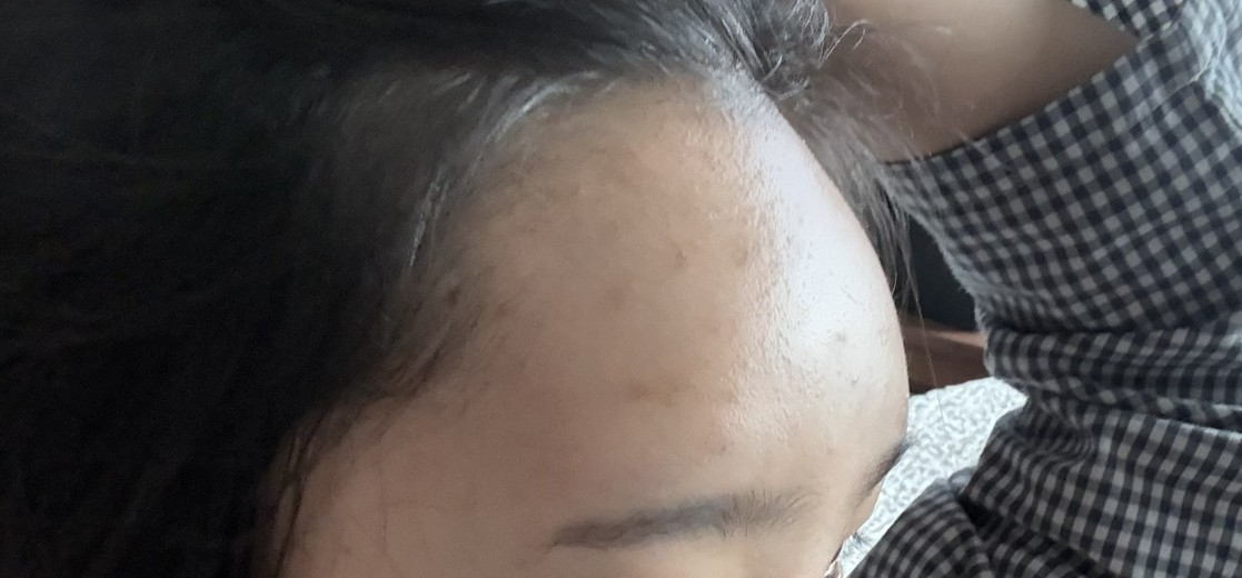 after photo: 이마필러, 관자놀이필러