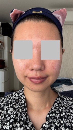 after photo: イオン導入