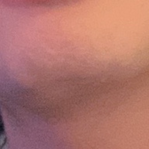 before photo: 턱제모, 인중제모, 아포지레이저