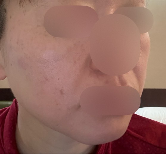 before photo: 糸リフト