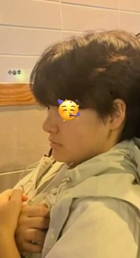 after photo: 비중격만곡증수술, 콧대(보형물), 코끝(자가연골)