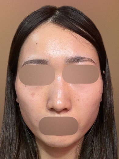 after photo: ハイドラフェイシャル, 診断・検査