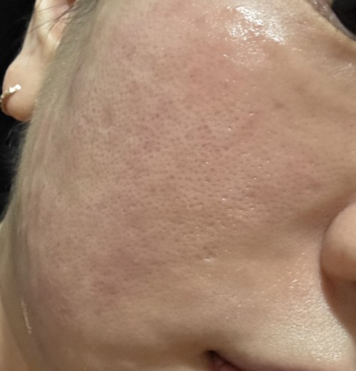 after photo: 리쥬란힐러, 쥬베룩