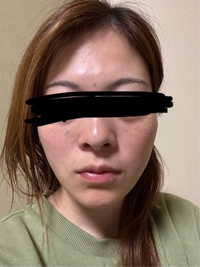 after photo: リジュランヒーラー