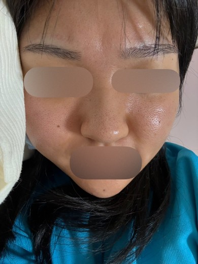 after photo: ハイドラフェイシャル