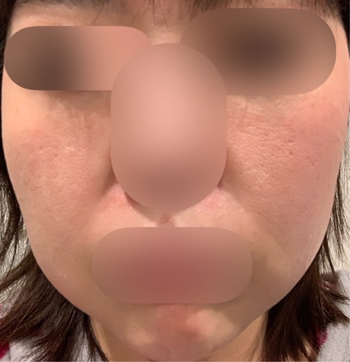 after photo: エレクトロポレーション, ハイフ(HIFU)