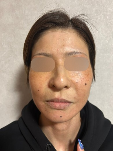 before photo: IPL(光/フォト治療), エレクトロポレーション