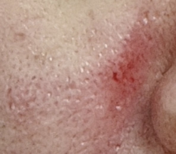 after photo: ダーマペン, PRP皮膚再生療法