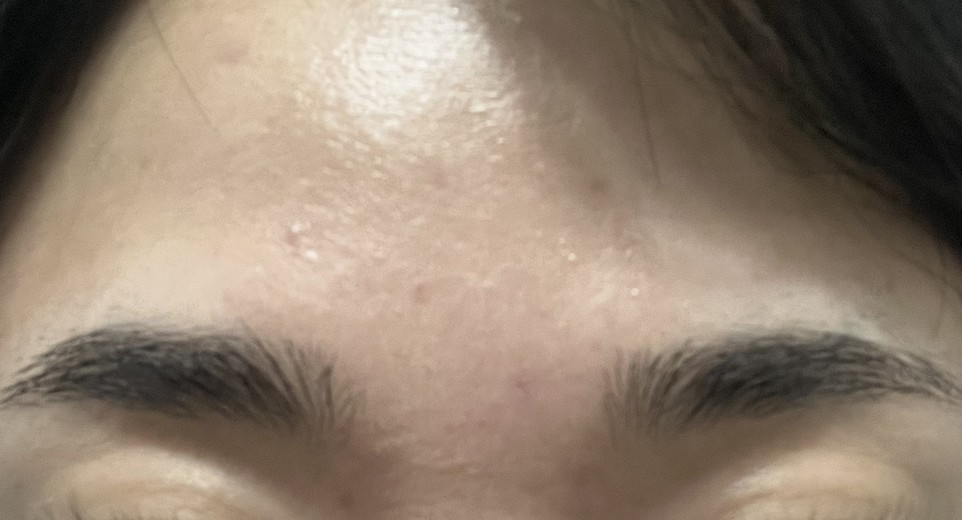 after photo: 사각턱보톡스