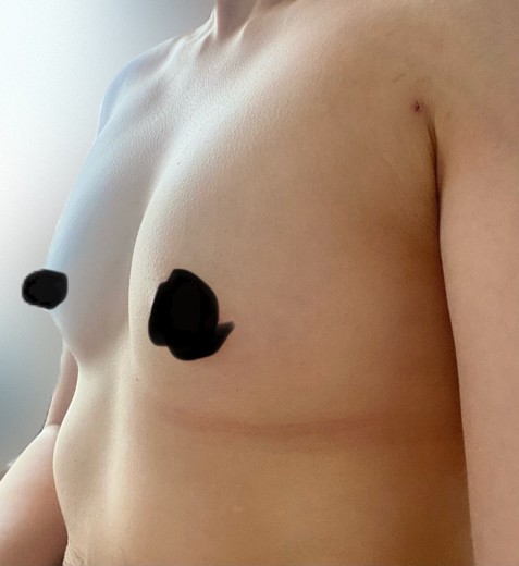 after photo: 豊胸(脂肪注入)
